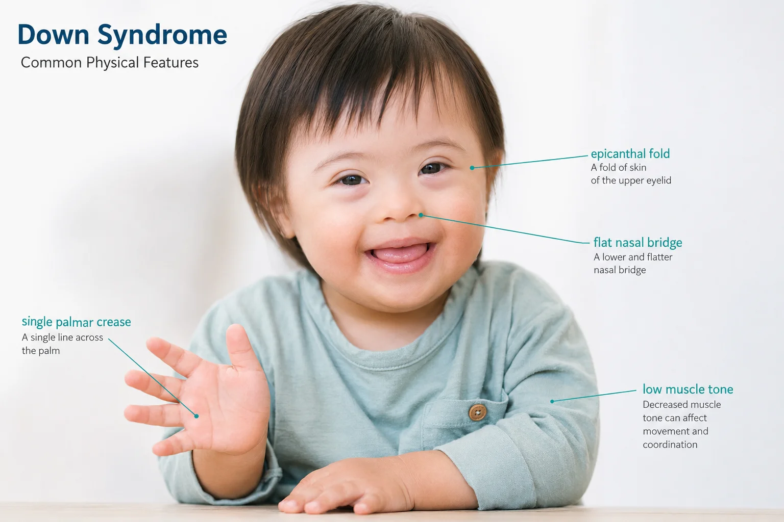 Down Syndrome (Trisomy 21): Types, Causes, Diagnosis & Karyotype Test Guide