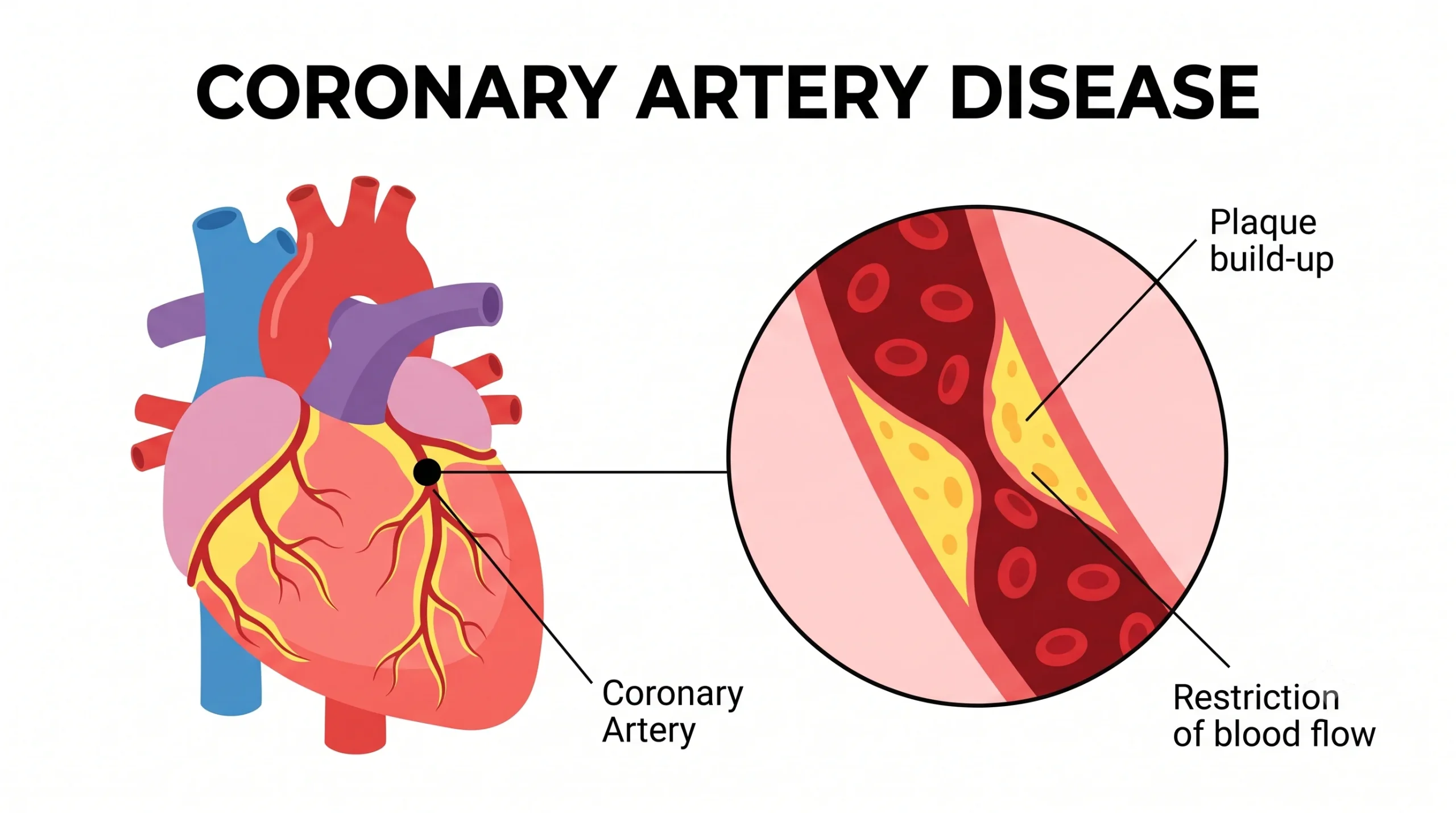 Coronary Artery Disease progression showing plaque buildup in arteries and its impact on heart health.